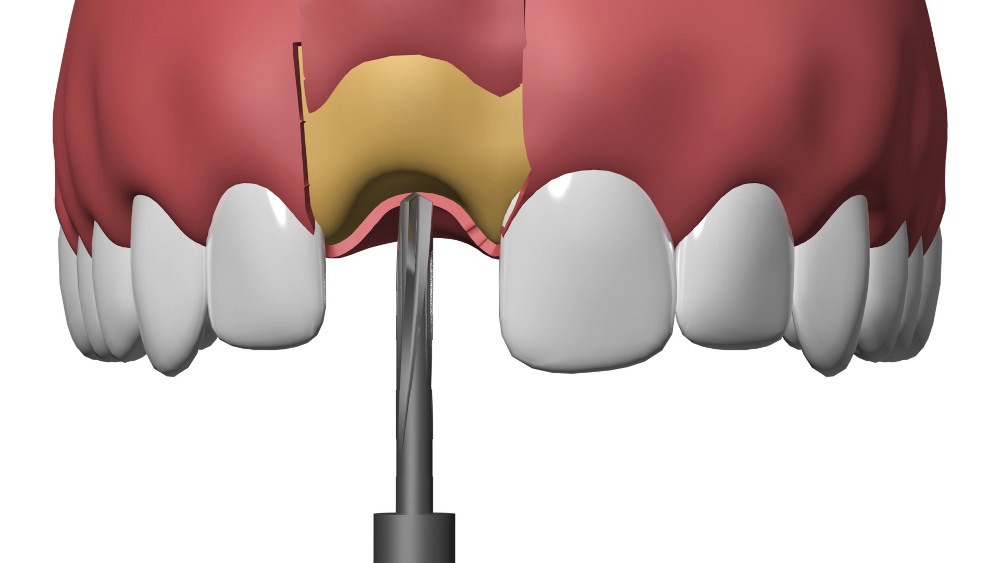 Implant dentaire Nimes